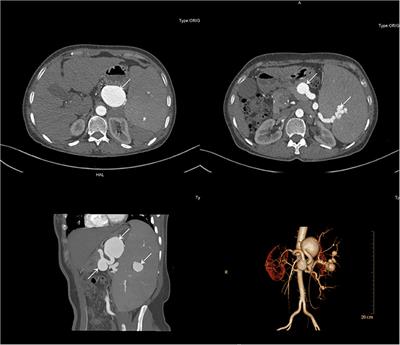 Multiple Splenic Artery Aneurysms: A Case Report and Review of the Literature